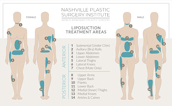 Advances in liposuction create safer, more effective body-contouring  options, Plastic Surgery
